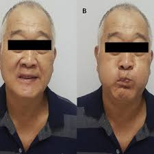 PDF) Old Age Lower Lip Cancer Defects Reconstruction by Abbe-Estlander Flap