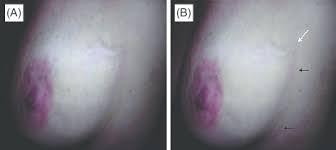 It sometimes occurs in the arm or penis. A A Subcutaneous 6 Cm Cord Like Structure In The Upper Outer Quadrant Download Scientific Diagram