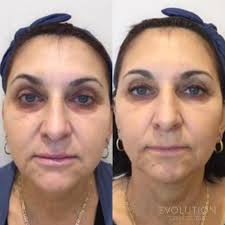 Your physician will go over the risks. Under Eye Circle Treatments Sydney Get Rid Of Dark Circles Under Eyes Elc