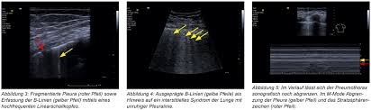 You look for the absence of lung sliding, the absence of comet tail artifacts. Bayerisches Arzteblatt