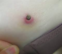 Image result for infected tick bite