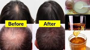 With some conditions, such as patchy hair loss (alopecia areata), hair may regrow without treatment within a year. Super Fast Natural Hair Growth Treatment At Home World Best Magical Hair Growth Treatment Youtube