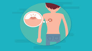 Bisul adalah benjolan berisi nanah yang berada di kulit anda. Operasi Solusi Bagi Bisul Yang Selalu Kembali