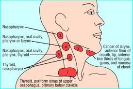 Head and neck cancer symptoms may include a lump in the neck or a sore in the mouth or the throat that does not heal and may be painful, a sore throat surgery for head and neck cancers may affect the patient's ability to chew, swallow, or talk. Lymph Nodes Corresponding Illness Lymphmassage Lymph Massage Neck Lymph Massage Lymph Nodes Medical Therapy