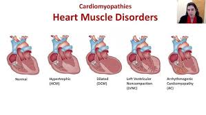 Image result for Cardiomyopathy