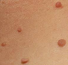 Burns, permanent changes to your skin color, and scars can occur. Mole Skin Tag Keratosis Removal Clinic Serving Brantford On Laser Aesthetics 905 332 9930