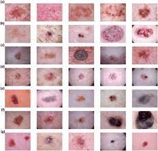 Actinic keratosis (ak) is the most common precancer that forms on skin damaged by chronic exposure to ultraviolet (uv) rays from the sun and/or indoor tanning. Sample Skin Cancer Images From Ham10000 Dataset A Actinic Keratosis Download Scientific Diagram