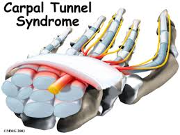 Carpel Tunnel Syndrome The Hand Thumb Specialty Center