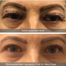 Yasla Birlikte Gevseyen Ust Kapaklarda Etkin Sonuc Sadece Ust Kapak Blefaroplasti Dedigimiz Estetik Kapak Ameliyatiyla Saglanabilir Estetik Plastic Yastiklar