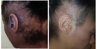 Nov 29, 2015 at 2:43 pm. Should I Continue With Cortisone Injections Will My Hair Fall Out If I Do So Photo