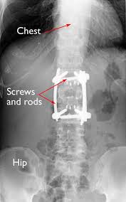Check spelling or type a new query. Fractures Of The Thoracic And Lumbar Spine Orthoinfo Aaos