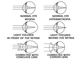 Image result for Refractive Error