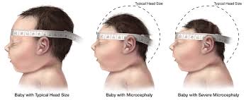 Image result for zika virus