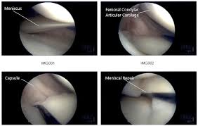 Each knee has two menisci (plural of meniscus). Case Study Meniscal Repair Of The Medial Meniscus Partial Meniscectomy Of The Lateral Meniscus And Microfracture Of The Right Knee