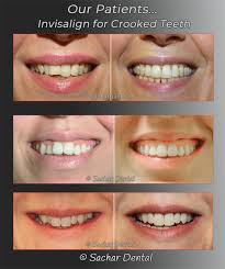 Check spelling or type a new query. Dentist Nyc Invisalign For Crooked Teeth Sachar Dental Nyc