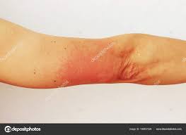 Image result for Photodermatitis