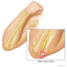 It isn't pleasant, but treatments and simple changes to your routine can help you feel. Ulnar Nerve Cubital Tunnel Syndrome Mayo Clinic Orthopedics Sports Medicine