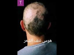 هوس نتف الشعر مع د حسام كوكب قناة Takiddالطبية Incoming Call Screenshot Incoming Call