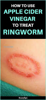 Can you keep a hand sanitizer in your car? 18 Best Home Remedies For Ringworm Skin Ideas Home Remedies For Ringworm Ringworm Ringworm Remedies