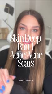 Can Deep Pitted Acne Scars Go Away? Treating deep pitted scars takes time  and the right approach: 1️⃣ Start with facials and microdermabrasion to  retexture and clear bacteria. 2️⃣ Try chemical peels