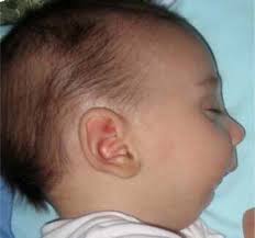 Pierre Robin sequence: appearances and 25 years of experience with an  innovative treatment protocol