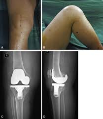 Image result for Ballottable Patella Sign