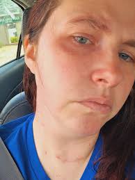 Could heat and sun reactions be related to MCAS?