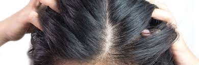 Otc products may help manage symptoms if you have mild scalp psoriasis. Psoriasis And Hair Loss Is It Connected