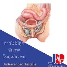 Image result for Undescended Testicle