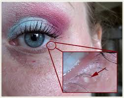 Image result for milium cyst on eyelid