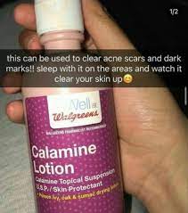 Calamine lotion may help to treat the symptoms of mild to moderate acne in some people. Pin On Body Hacks