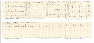 23 мая 1995 года) — американская порноактриса и модель. Normal Ecg Finding Of The 53 Year Old Lady Presented With Left Sided Download Scientific Diagram