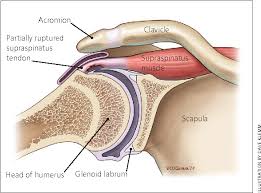 It originates from the medial aspect of the supraspinous fossa, a concave depression located above the spine of the scapula. Figure 2 View Of The Shoulder In The Transverse Plane Showing A Partial Avulsion Of The Supraspinatus Tendon Shoulder Anatomy Supraspinatus Muscle Athlete