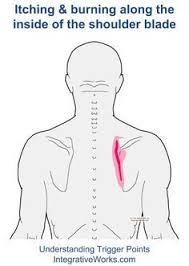 Burning And Itching Along The Shoulder Blade Integrative Works Trigger Points Shoulder Blades Shoulder Trigger Points