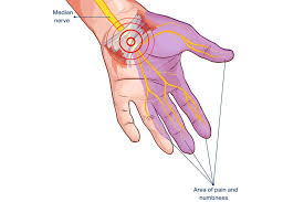 Le canal carpien est l'espace entre les os du poignet et le ligament qui les recouvre. Tunnel Carpien Monchiro Ca Votre Chiropraticien Au Quebec On S Occupe De Vous