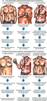 2017 Ishne Hrs Expert Consensus Statement On Ambulatory Ecg And External Cardiac Monitoring Telemetry Steinberg 2017 Annals Of Noninvasive Electrocardiology Wiley Online Library