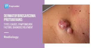 Image result for Dermatofibrosarcoma Protuberans