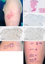 The vaccines approved for use in the uk have met strict standards of safety serious allergic reactions are rare. Delayed Large Local Reactions To Mrna Vaccines Nejm