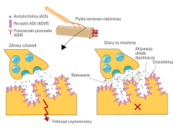 Myasthenia gravis, chronic autoimmune disorder characterized by muscle weakness and chronic fatigue that is caused by a defect in the transmission of nerve impulses from nerve endings to muscles. Neurologia Po Dyplomie Miastenia