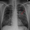 Dear concerned, lung cancer and emphysema are not the same things. 1