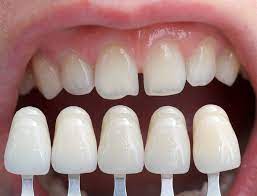 Are Dental Veneers For Me Dental Veneers Dental Dentistry