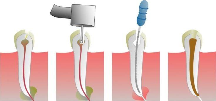 Root Canal Treatment product image
