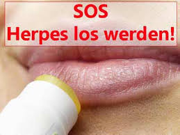 Was Hilft Gegen Herpes 5 Tipps Das Solte Jeder Wissen
