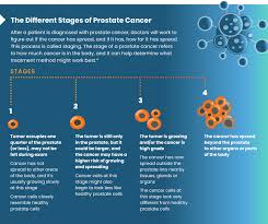 Image result for Prostate Cancer Staging