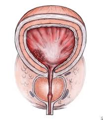 Pin On Prostate Health