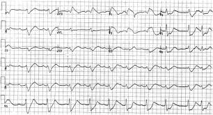 Image result for Flecainide Overdose
