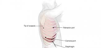 If cancer is diagnosed, relieving symptoms remains an important part of cancer care and treatment. Pulmonary Blebs And Bullae