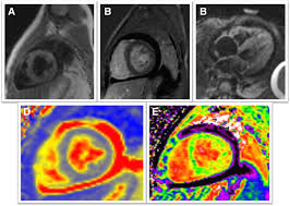 Are you dealing with new onset dillated cardiomyopathy or myocarditis? Diagnostic Performance Of Cardiovascular Magnetic Resonance Native T1 And T2 Mapping In Pediatric Patients With Acute Myocarditis Journal Of Cardiovascular Magnetic Resonance Full Text