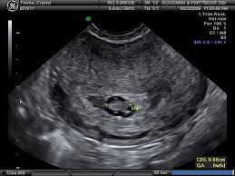 Pin On Ob Gyn Ultrasound 101 Mod 2