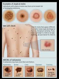 Some types of skin cancer are more dangerous than others, but if you have a spot. When Last Did You Have Your Moles Not Today Melanoma Facebook